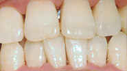 牙博士口腔牙周综合治疗案例一:治疗后