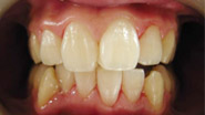 牙博士口腔牙周综合治疗案例二:治疗后